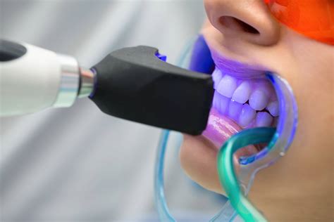 blanqueamiento dental laser caracas